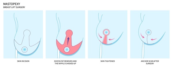 Breast Procedures